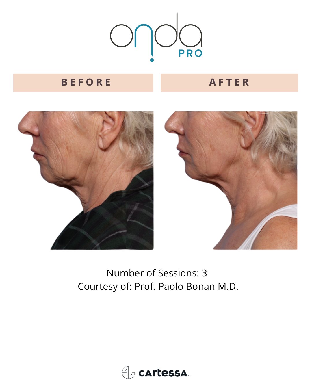 Neck before and after 3 ONDA PRO sessions