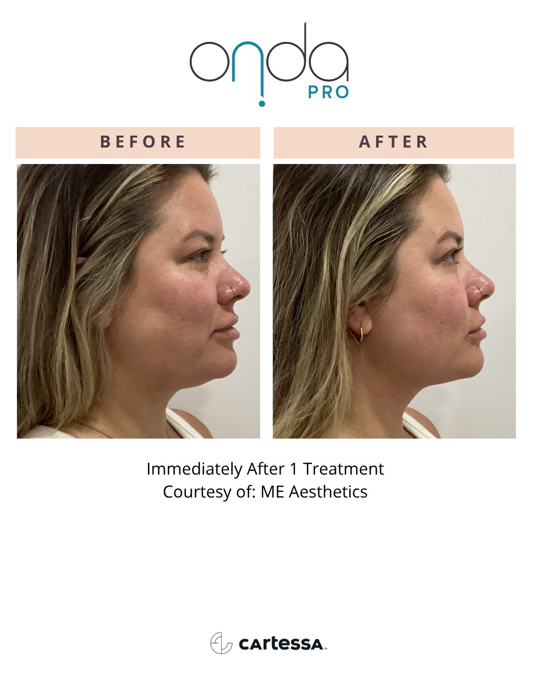 Facial profile before and immediately after 1 ONDA PRO treatment
