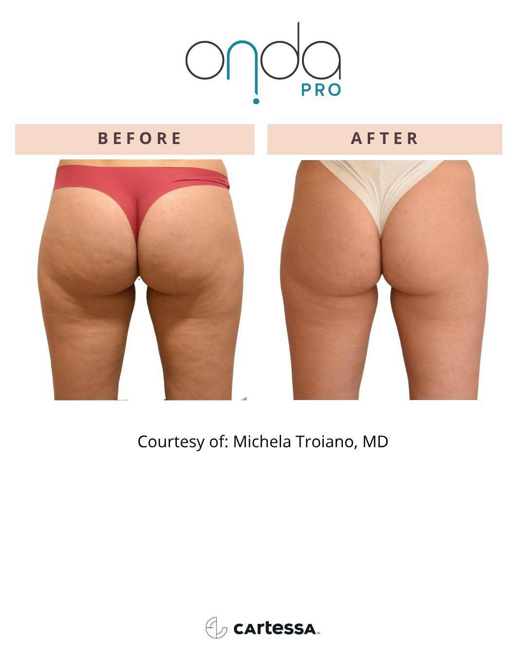 Buttocks cellulite before and after ONDA PRO treatment