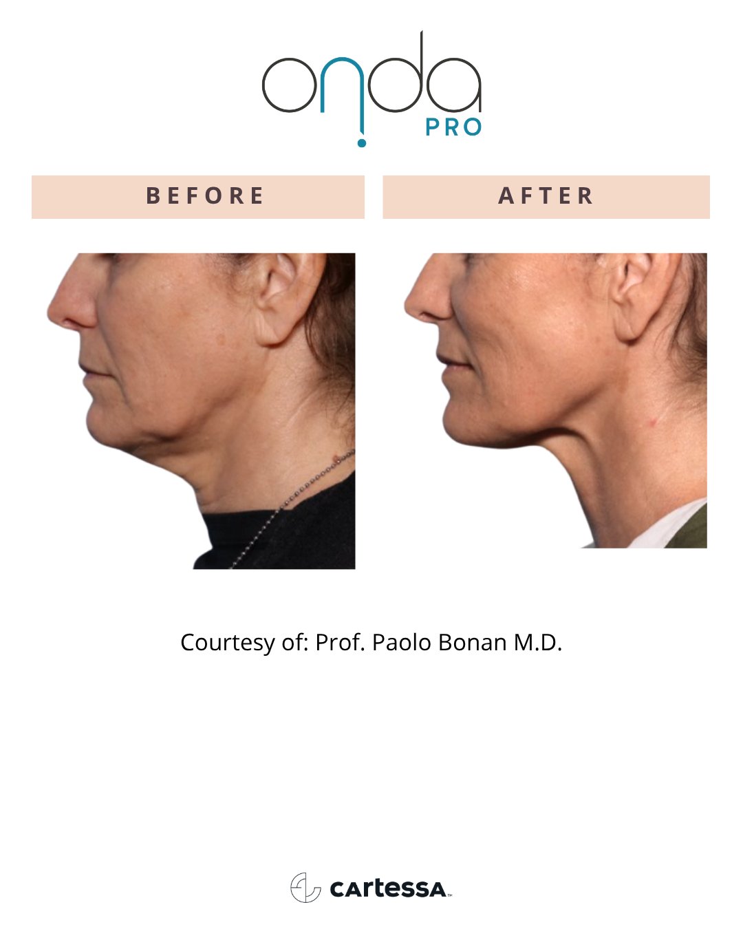 Jawline before and after ONDA PRO treatment