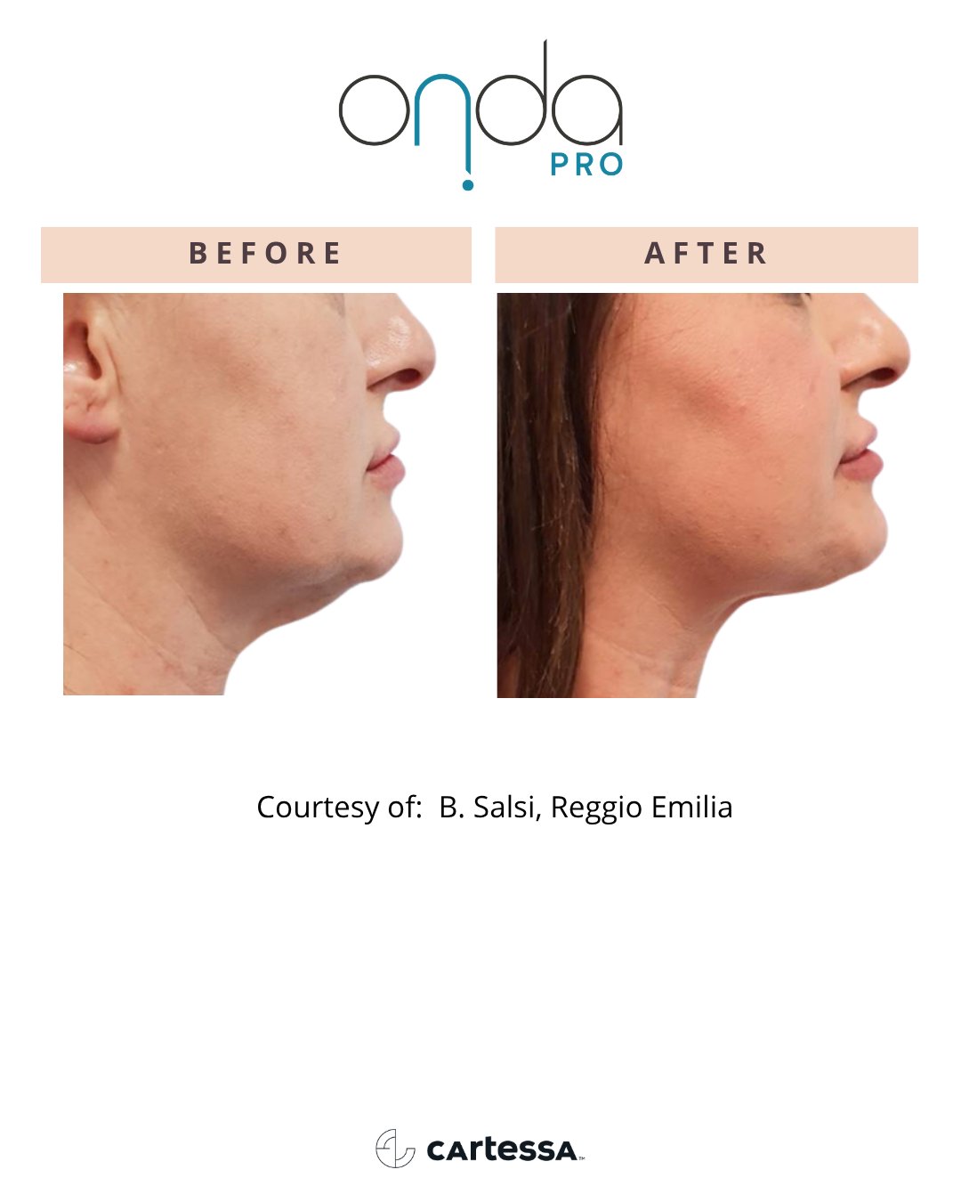 Chin profile before and after ONDA PRO treatment