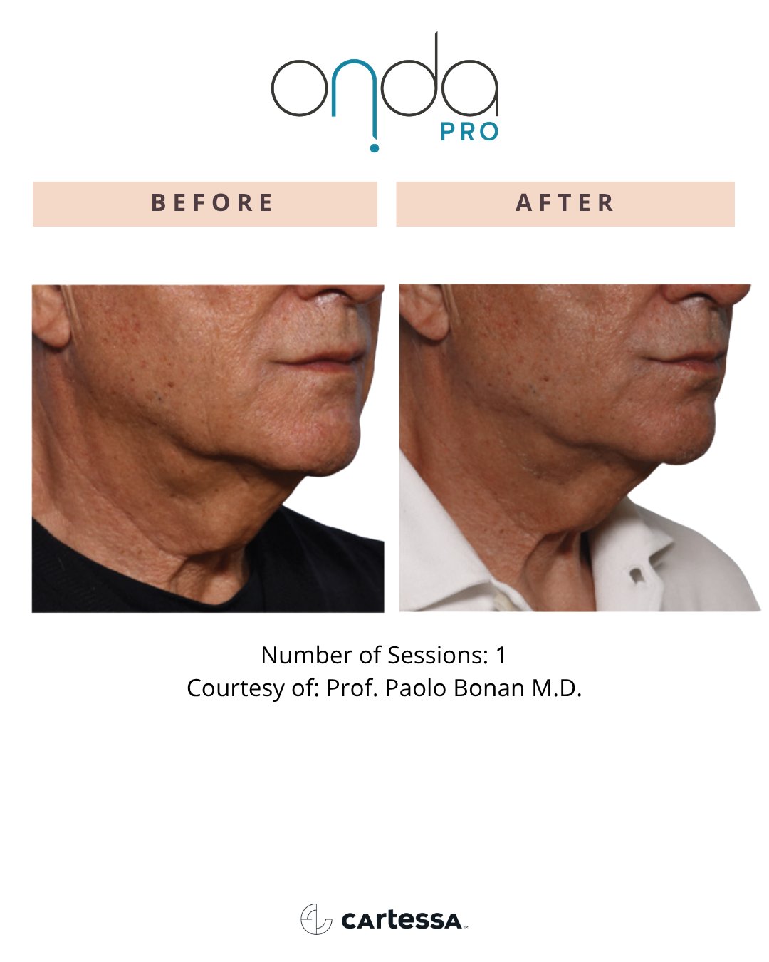 Jawline before and after 1 ONDA PRO session