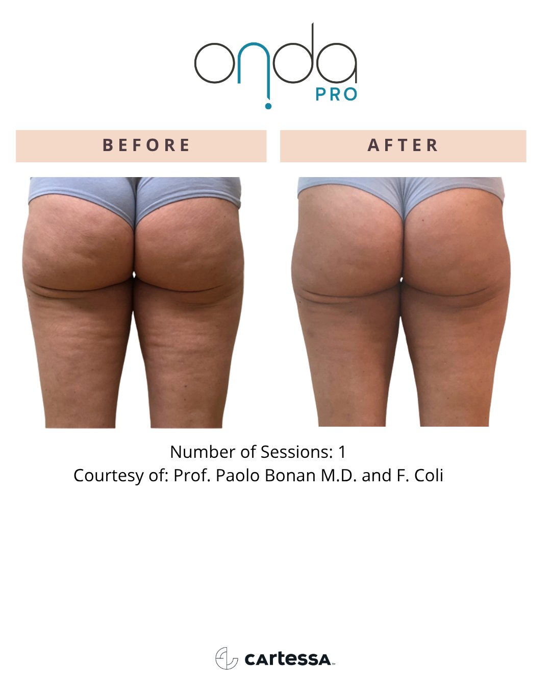 Buttocks and thighs cellulite before and after 1 ONDA PRO session