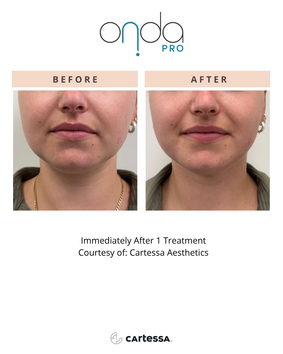 Chin before and immediately after 1 ONDA PRO treatment
