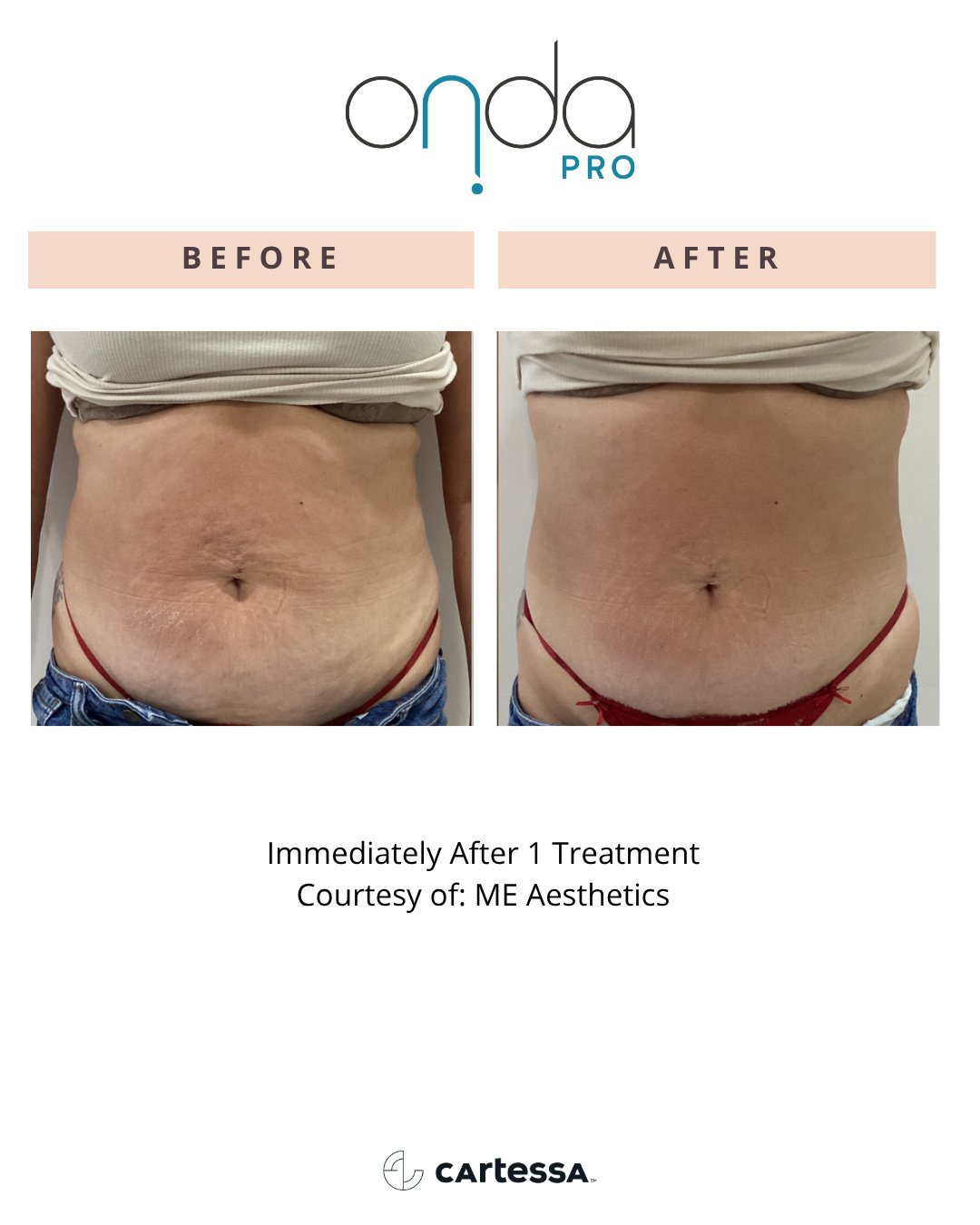 Abdomen before and immediately after 1 ONDA PRO treatment