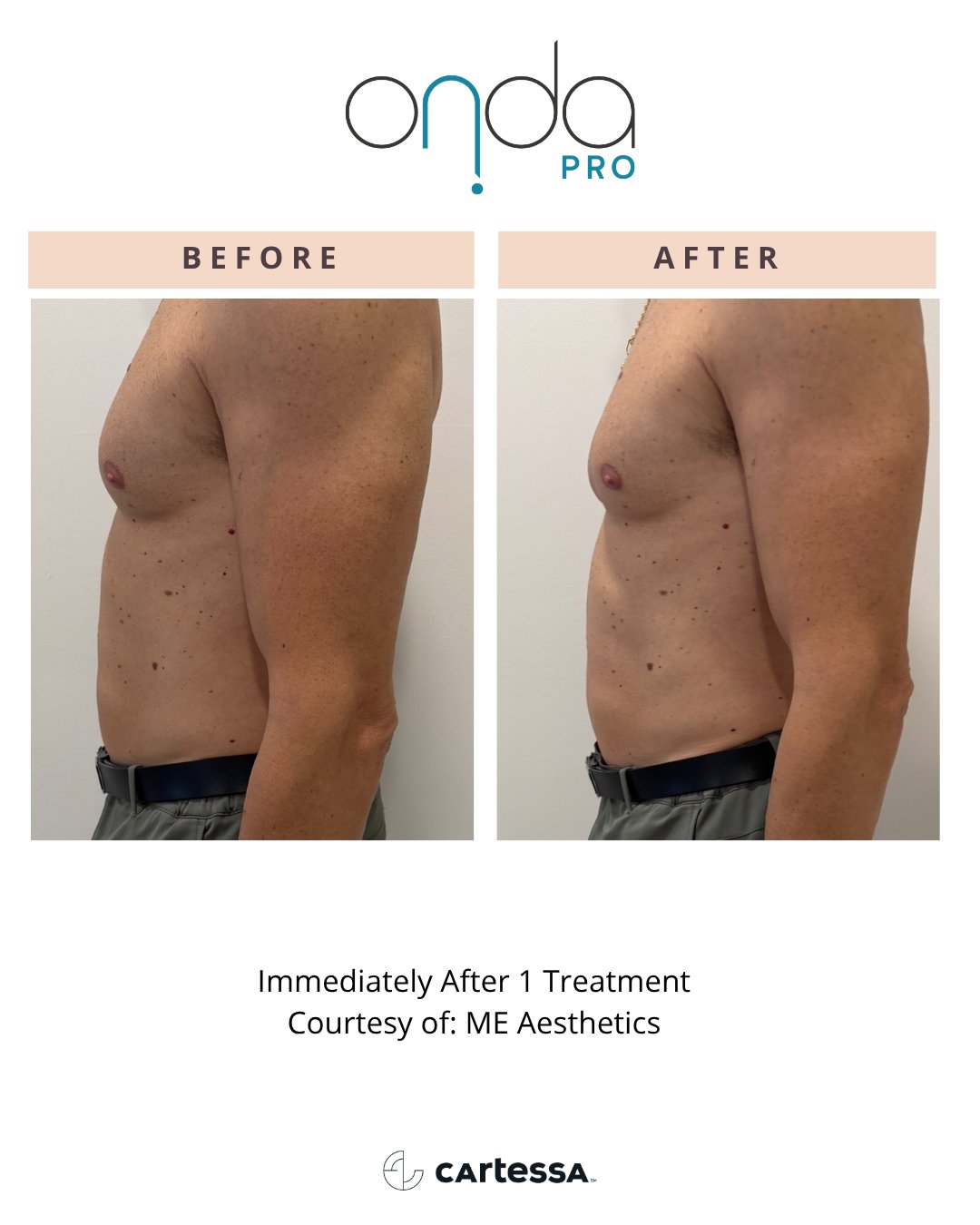 Torso before and immediately after 1 ONDA PRO treatment