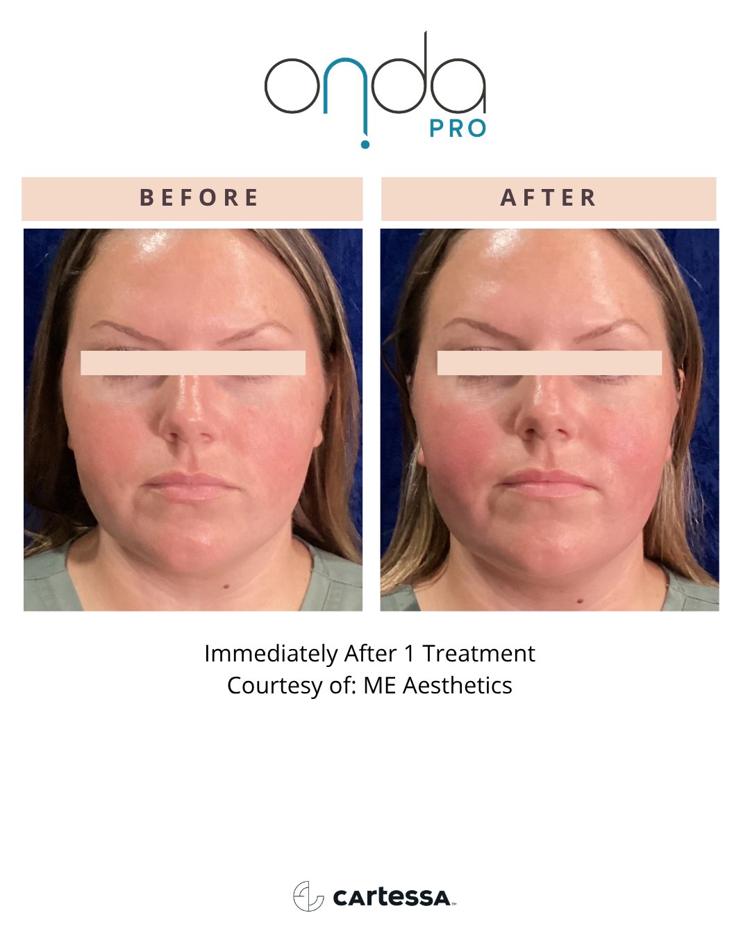Face before and immediately after 1 ONDA PRO treatment
