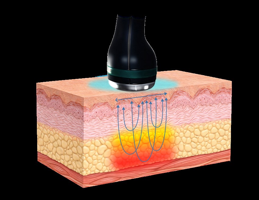 Diagram of Coolwaves energy passing through the skin's surface into subcutaneous tissue